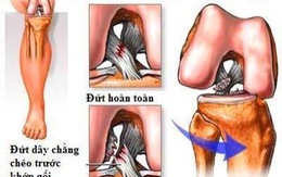 ​Đứt dây chằng chéo trước khớp gối: tổn thương thường bị bỏ sót