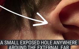 ​Tại sao một số người khi sinh ra đã có một lỗ nhỏ trên tai?