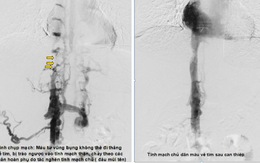 ​Điều trị thành công ca mắc hội chứng Budd-Chiari hiếm gặp