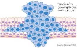 10 cách “né” ung thư
