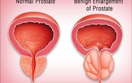 4 mẹo ứng phó với tuyến tiền liệt phì đại