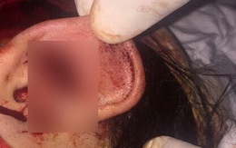 Một thiếu nữ bị 20 thanh niên đánh đập dã man, cắt tai
