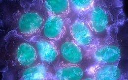​Xác định được các gene đột biến có khả năng gây bệnh ung thư vú