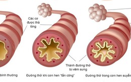 ​Lựa chọn kháng sinh trong điều trị bệnh viêm phế quản cấp