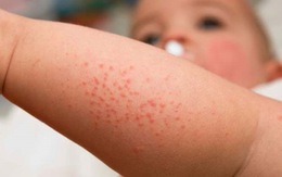 ​Phân biệt sốt phát ban và bệnh sởi ở trẻ em