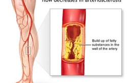 ​Viêm tắc động mạch chi dưới - bệnh lý dễ bị bỏ qua