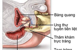 ​Những điều cần biết về ung thư tiền liệt tuyến