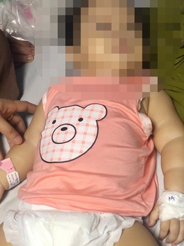 Bé gái 11 tháng tuổi ngộ độc chì nặng sau khi dùng thuốc gia truyền