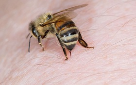 Nguy kịch, cẳng chân hoại tử vì dùng ong châm trị đau khớp gối