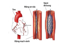 Dinh dưỡng và vận động sau đặt stent mạch vành