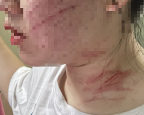Vụ thiếu nữ 17 tuổi bị mẹ ruột trói, đánh: Điều tra thêm hành vi bạo hành, ngược đãi con cái