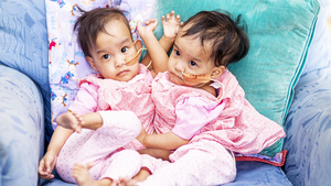 Phẫu thuật tách thành công hai bé gái Bhutan dính liền thân