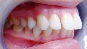 Khỏe đẹp cùng chuyên gia: Răng hô và hướng khắc phục - phần 2