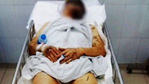 Công an đề nghị cấm anh ruột Việt kiều bị tạt axít, cắt gân chân xuất cảnh