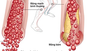 Nguy cơ đoạn chi do tắc động mạch chi dưới