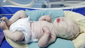 Video: Bé sơ sinh mắc bệnh cực hiếm, toàn thân bọc vảy trắng, nhiều vết nứt