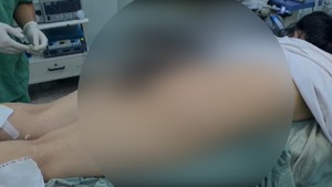 Video: Nữ bệnh nhân cấp cứu với chân chống xe máy đâm sâu vào vùng mông
