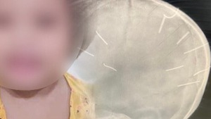 Video: Điều tra nhân tình của người mẹ vụ 'bé gái 3 tuổi có 9 vật thể giống đinh găm vào hộp sọ'