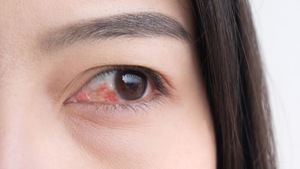 5 loại thuốc nhỏ mắt trị đau mắt đỏ mà bạn nên biết