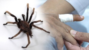 Một người dân ở Phú Quốc nhập viện do bị nhện độc cắn