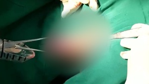Lấy dương vật giả dài 20cm ra khỏi trực tràng của nam bệnh nhân ở Cà Mau