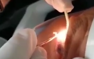 Video: Bác sĩ gắp 20 con giun từ mắt một người đàn ông