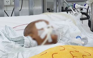Video: Bé trai 4 tuổi bị kéo đâm vào mắt, xuyên não nguy kịch