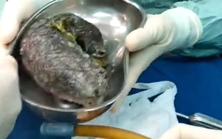 Video: Phẫu thuật lấy búi tóc nửa ký trong bụng bé gái 7 tuổi ở Quảng Ngãi