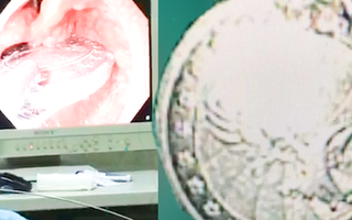 Video: Cấp cứu bé gái 6 tuổi trước nguy cơ nghẹt thở vì nuốt đồng xu