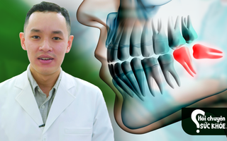 Răng khôn mọc lệch ảnh hưởng đến sức khỏe ra sao?