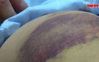 Mẹ kế dùng chày đánh con chồng đa chấn thương