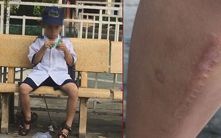 Cha ruột đánh con trai 7 tuổi gây nhiều thương tích