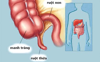 Viêm ruột thừa ở trẻ em khó chuẩn đoán