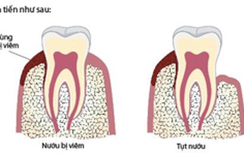 Tại sao cần phải cạo vôi răng?