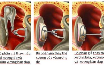 Vá màng nhĩ cải thiện khả năng nghe