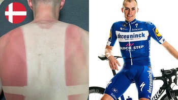 Đạp xe ở ban công, lưng cuarơ bị 'cháy nắng' thành lá cờ Đan Mạch
