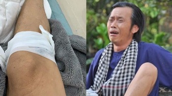 Hoài Linh bị thương phải băng chân, fan phì cười khi biết 'hung thủ'