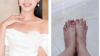 Hoa hậu Đỗ Thị Hà tự bóc điểm xấu trên cơ thể