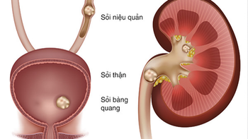 Vì sao Việt Nam được xem là 'vùng sỏi thế giới'?