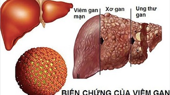 Xơi thực phẩm đường phố, coi chừng rước siêu vi viêm gan A