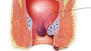 Thế nào là trĩ nội, trĩ ngoại?
