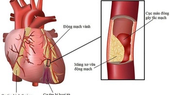 Bệnh động mạch vành, bạn có bao nhiêu phần trăm sẽ mắc phải?