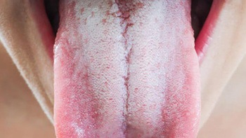 Lưỡi trắng có mối liên hệ gì với ung thư lưỡi?