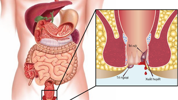 Đi cầu có máu, có phải bệnh trĩ?