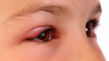 5 dấu hiệu ở mắt cần phải đi khám gấp