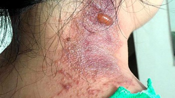 Nhiều bệnh nhân COVID-19 bị viêm da tiếp xúc do kiến ba khoang cắn