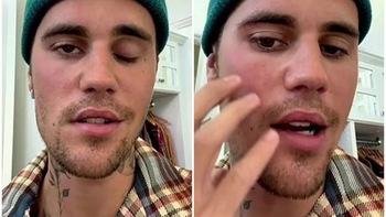 Justin Beiber 'ngừng hát' để tập trung trị chứng liệt nửa mặt