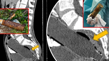 Cụ ông nhập viện với quả đạn pháo trong... trực tràng