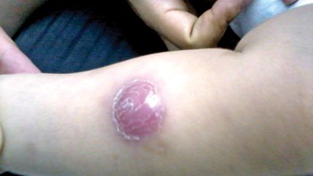 Nhiễm trùng da ở trẻ em