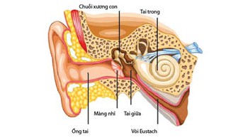 Coi chừng điếc vì viêm tai giữa
